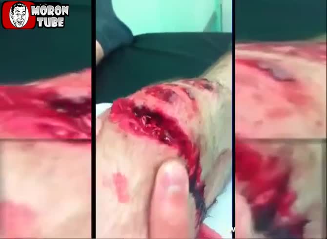 Video :Amazing knee injury (warning to the public)